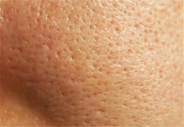 导致毛孔粗大的情况：皮肤老化松弛使用抗衰老护肤品 毛孔粗大 皮肤 第2张