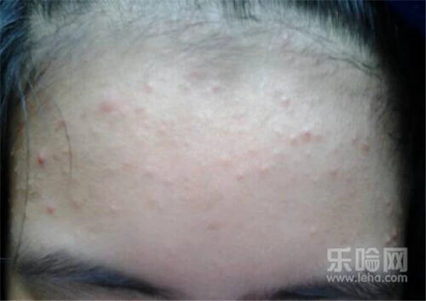 压力大额头长痘怎么办 护肤 第5张
