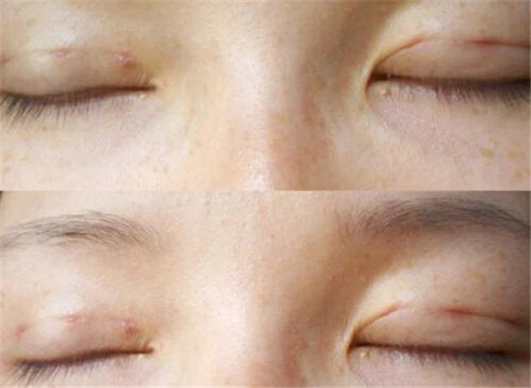 韩式三点双眼皮多久恢复好,韩式三点双眼皮恢复期 护肤 第2张 韩式三点双眼皮多久恢复好,韩式三点双眼皮恢复期 护肤 第2张