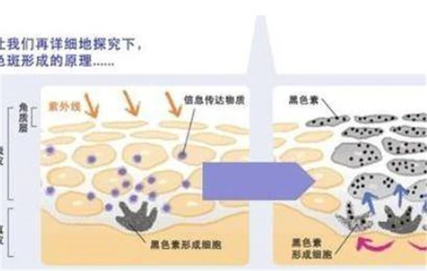 激光祛斑的副作用：处理不及时会留下疤痕 激光 祛斑 第3张