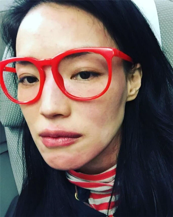 如何分辨「玫瑰痤疮」与「暗疮」，玫瑰痤疮常见4大病发阶段 玫瑰痤疮 暗疮 第5张