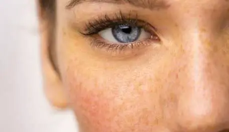 祛雀斑方法有哪些 祛雀斑 祛雀斑方法 美妆 第2张