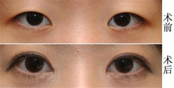 割双眼皮有什么危害性，埋线双眼皮后遗症 护肤 第4张