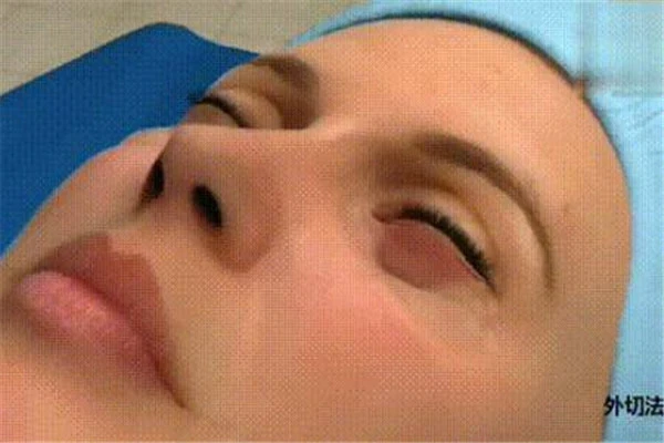 让眼袋消失的「妙招」：「外路」去眼袋紧致下眼皮 眼袋 妙招 第3张