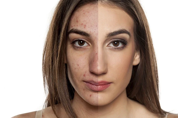 脸上长斑的原因有哪些，斑是怎么长出来的 皮肤 第3张