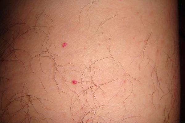 因为天气热脸上长红疙瘩怎么办 面部 第1张