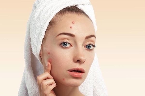 痘痘肌护肤六大注意事项 肌肤 第1张