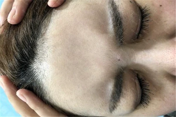 消除川字纹可常按摩，注意紫外线做好防晒工作 消除 川字纹 第2张