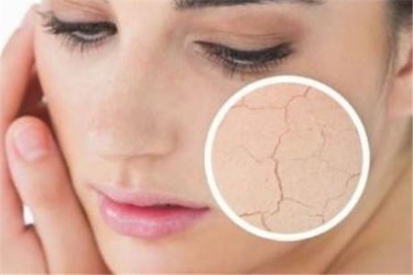 冬季皮肤干裂多喝水，蜂蜜红枣水滋阴润肺调理脸色 冬季 皮肤 第1张