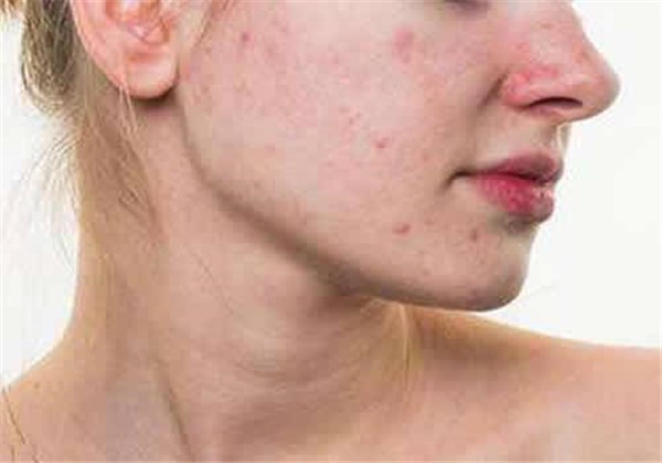 氨基酸洗面奶可以祛痘吗，氨基酸洗面奶怎么用祛痘 护肤 第1张