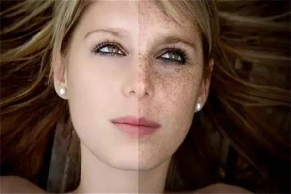 脸上皱纹哪种因素造成的，脸部的皱纹还能去掉吗 脸上 皱纹 第3张