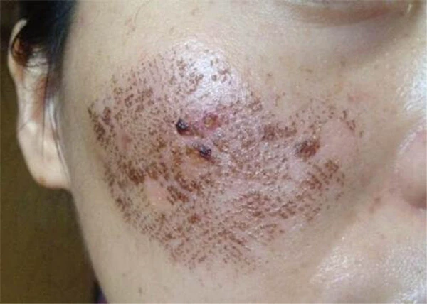 点阵激光后多久恢复正常肤色 护肤 第3张