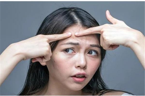 额头长痘的原因：饮食不健康加重废物积累 额头 长痘 第3张