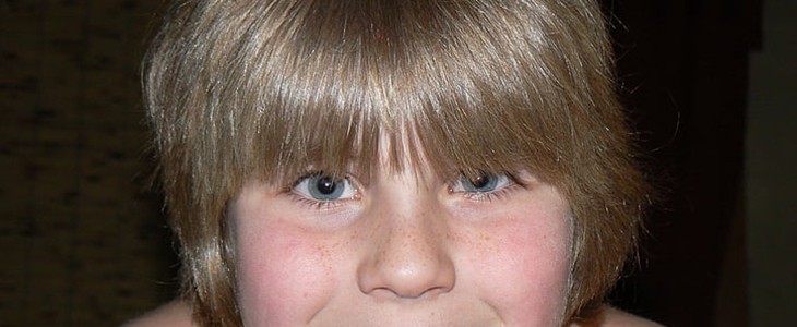 雀斑是怎么形成的 雀斑 美妆 第1张