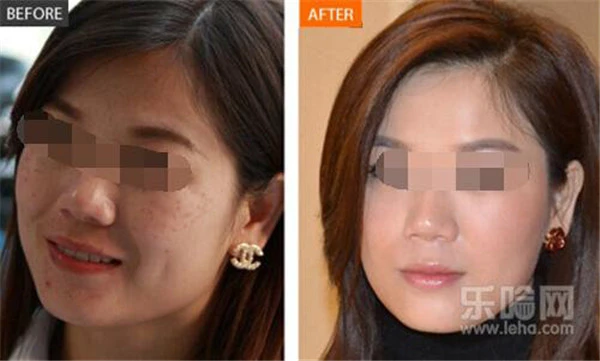 光子祛斑后如何保养 护肤 第6张