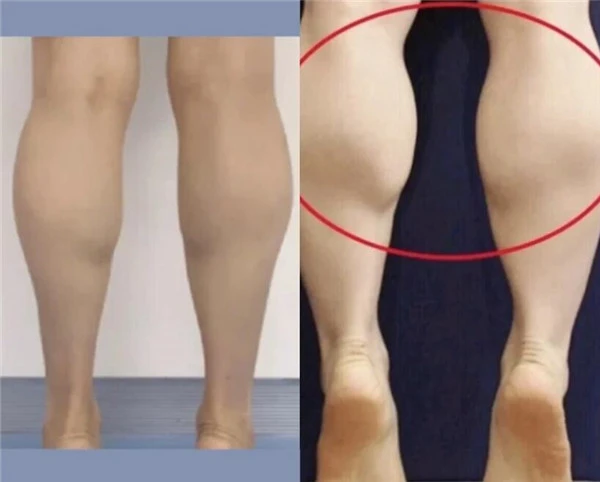 轻松改变小腿外翻瘦出筷子腿！如何判断小腿肌类型 筷子腿 小腿外翻 第3张