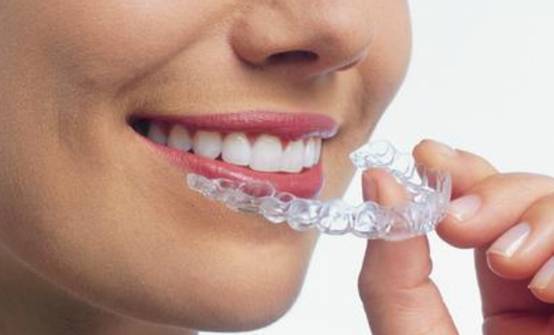 隐适美不适合哪些人群 隐适美 隐适美怎么样 美妆 第1张