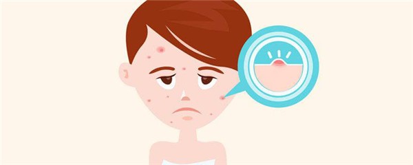 闭口快好的征兆,长闭口了怎么办 护肤 第1张 闭口快好的征兆,长闭口了怎么办 护肤 第1张