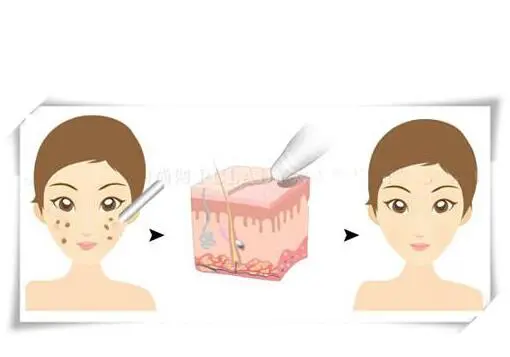 晒斑是如何产生的，晒斑产生的原因 晒斑 美容 第2张