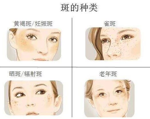 药水祛斑的危害与效果 药水祛斑|药水祛斑危害 药水祛斑 药水祛斑危害 美妆 第2张