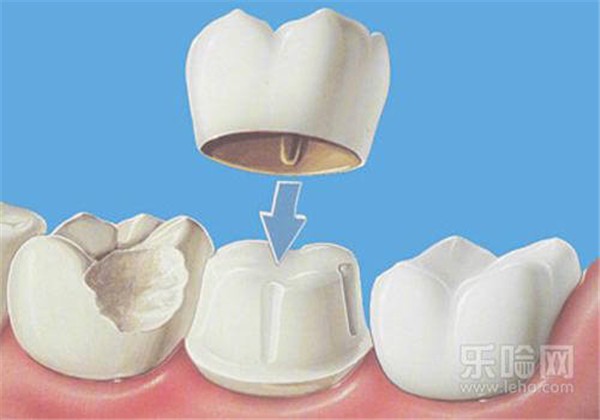 做烤瓷牙磨牙疼吗 护肤 第1张