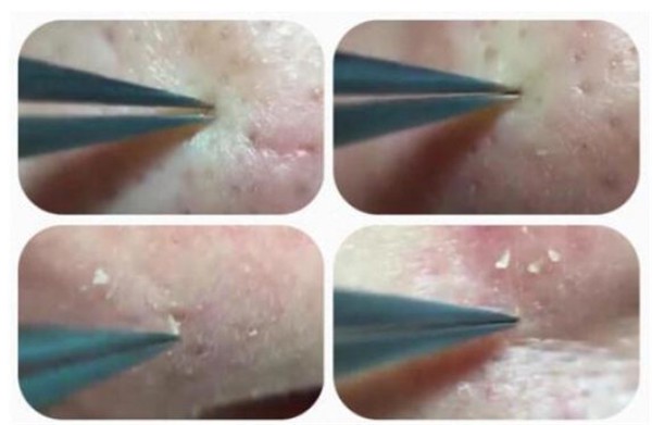 用镊子拔黑头毛孔会变大吗 黑头 毛孔变大 美妆 第1张