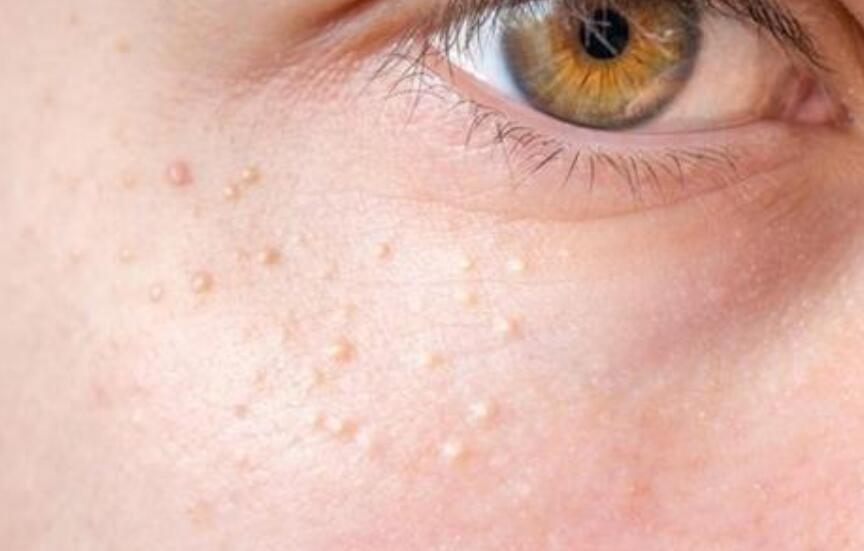 脸上长脂肪粒怎么办，白色小米粒去除方法 脂肪粒 脂肪粒去除 盘点脸上脂肪粒去除方法 美容 第1张