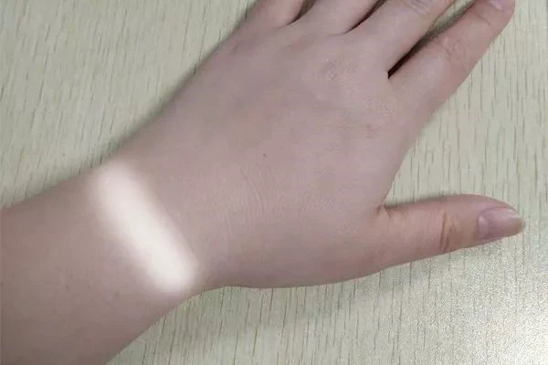 脸上有斑怎么办，最简单有效祛斑的方法有哪些 黑色素 第2张