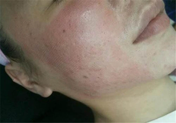 点阵激光后多久恢复正常肤色 护肤 第7张