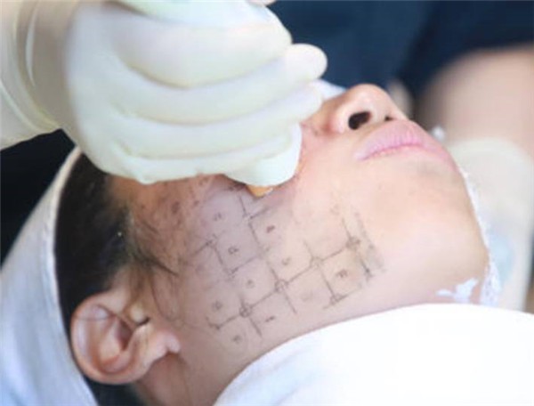 热玛吉的原理和功效维持多久 热玛吉 热玛吉功效 美妆 第1张