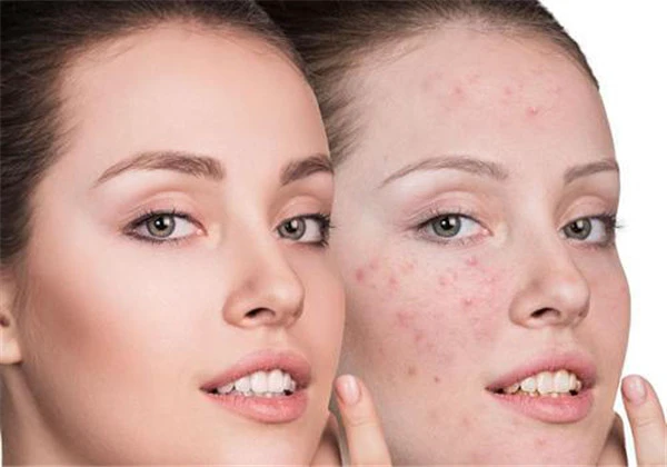 白瓷娃娃的危害 护肤 第2张