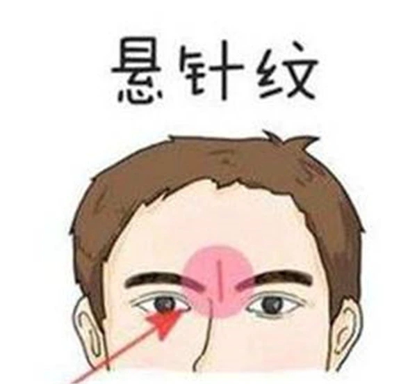 悬针纹怎么去除小偏方 悬针纹 去除悬针纹 美妆 第2张