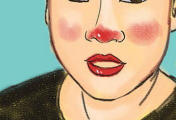 红鼻头怎么办，酒糟鼻改善方法 鼻子 红鼻头怎么样 鼻子老是红红的怎么办 美容 第1张