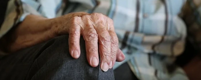 黄褐斑是什么原因引起的 黄褐斑 美妆 第3张