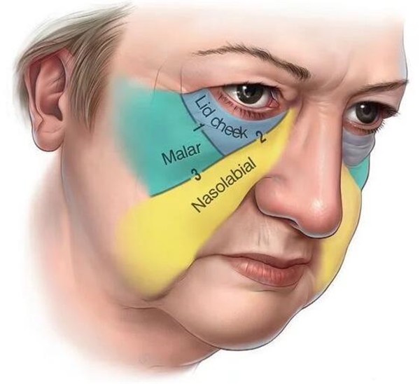 有严重泪沟的人如何改善，泪沟的形成原因都有哪些 泪沟 原因 第1张