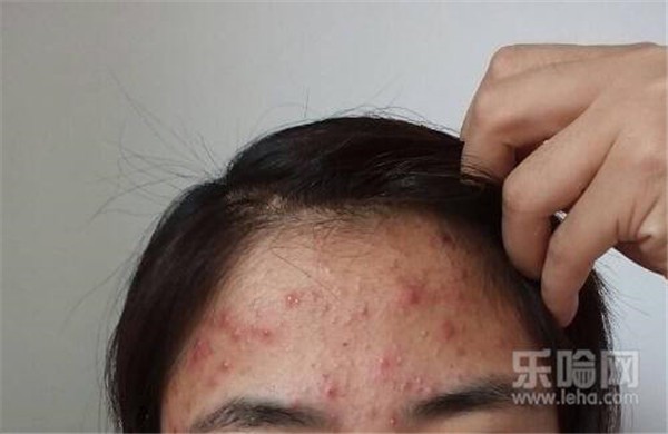 压力大额头长痘怎么办 护肤 第1张