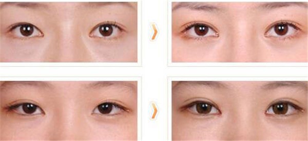 割双眼皮有什么危害性，埋线双眼皮后遗症 护肤 第1张
