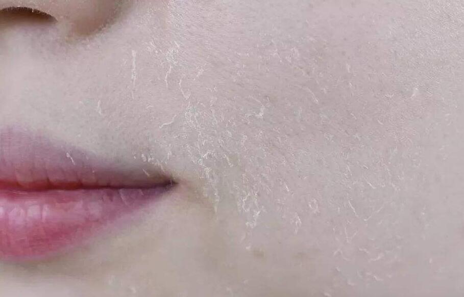 每次涂完粉底毛孔里有白点怎么办，化妆时卡粉解决方法 卡粉 涂完粉底毛孔里都是粉 涂完粉底毛孔里都是粉卡粉起皮怎么办 美妆 第1张