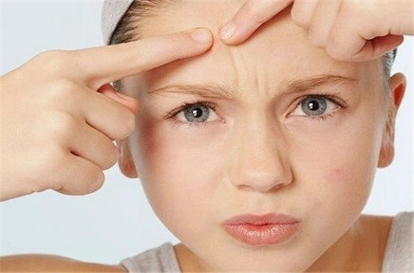 挤完痘痘后怎样消除红肿 护肤 第3张