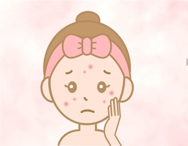 如何分辨「玫瑰痤疮」与「暗疮」，玫瑰痤疮常见4大病发阶段 玫瑰痤疮 暗疮 第7张