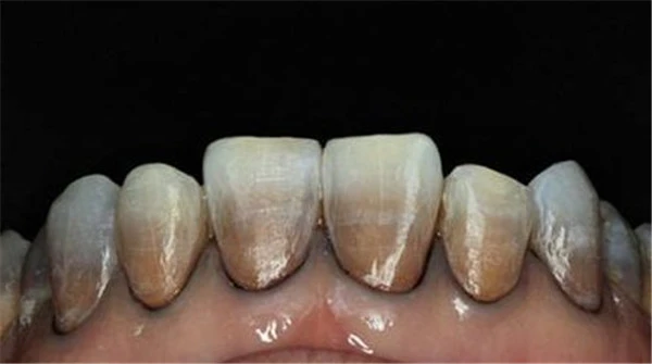 如何会拥有美白亮丽的牙齿，牙黄的美白方式有哪些 牙黄 美白 第4张
