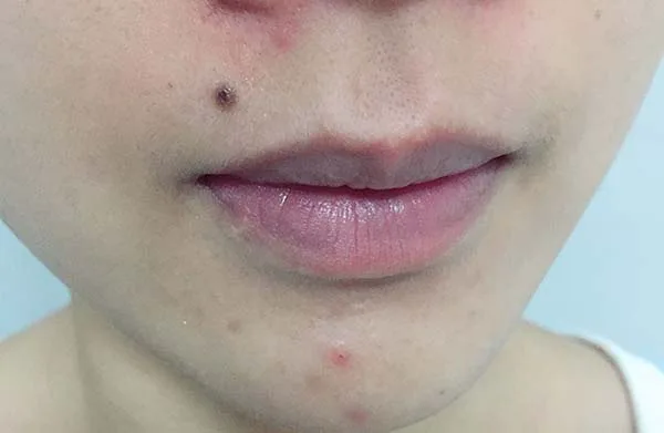 达尔肤杏仁酸温和焕肤精华液怎么样,达尔肤杏仁酸温和焕肤精华液使用测评 达尔肤 精华 第4张 达尔肤杏仁酸温和焕肤精华液怎么样,达尔肤杏仁酸温和焕肤精华液使用测评 达尔肤 精华 第4张