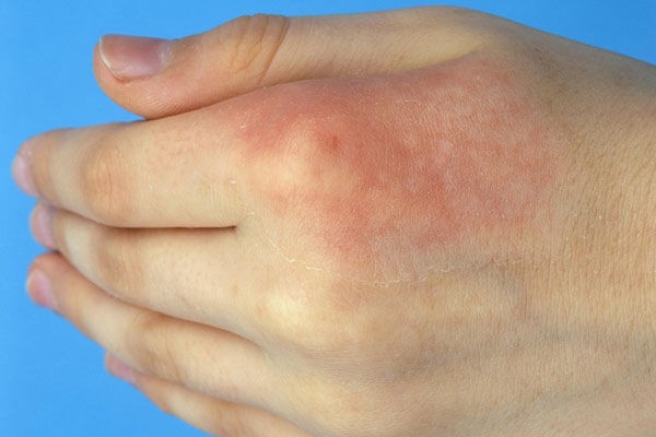 有了疤痕怎么办，有没有治疗疤痕的好办法 疤痕 第1张