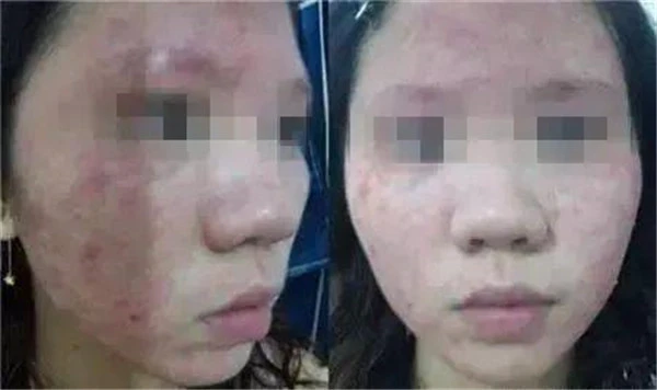 皮肤过敏的原因有哪些，哪些人容易皮肤过敏 过敏 皮肤 第3张