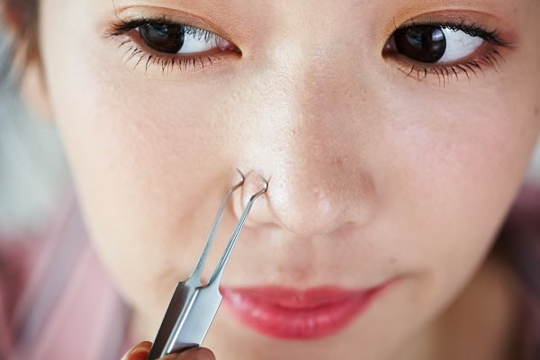 痤疮和痘痘是同一个东西吗，有哪些常见治疗方法 痤疮 第1张