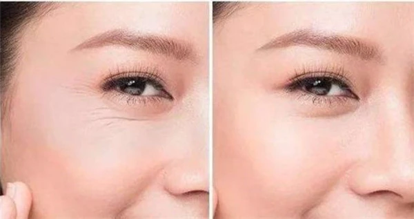怎样去除眼角鱼尾纹 美妆 第2张