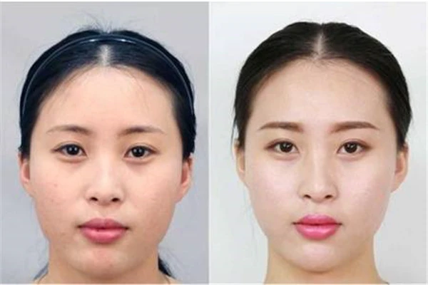 打瘦脸针的危害:萎缩咬肌、长期注射损伤神经 瘦脸针 危害 第3张 打瘦脸针的危害:萎缩咬肌、长期注射损伤神经 瘦脸针 危害 第3张