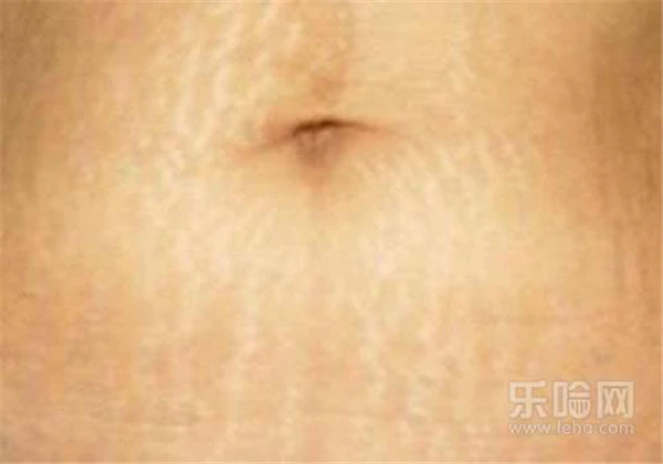 膨胀纹会自动消失么 护肤 第5张