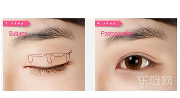 埋线双眼皮好吗 护肤 第2张
