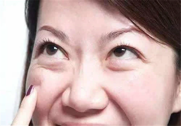 下眼袋可以去掉吗，只要发现的早，去除下眼袋就不是梦想！ 护肤 第4张